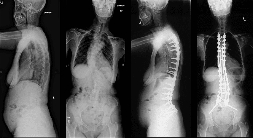 Adult Spinal Deformity