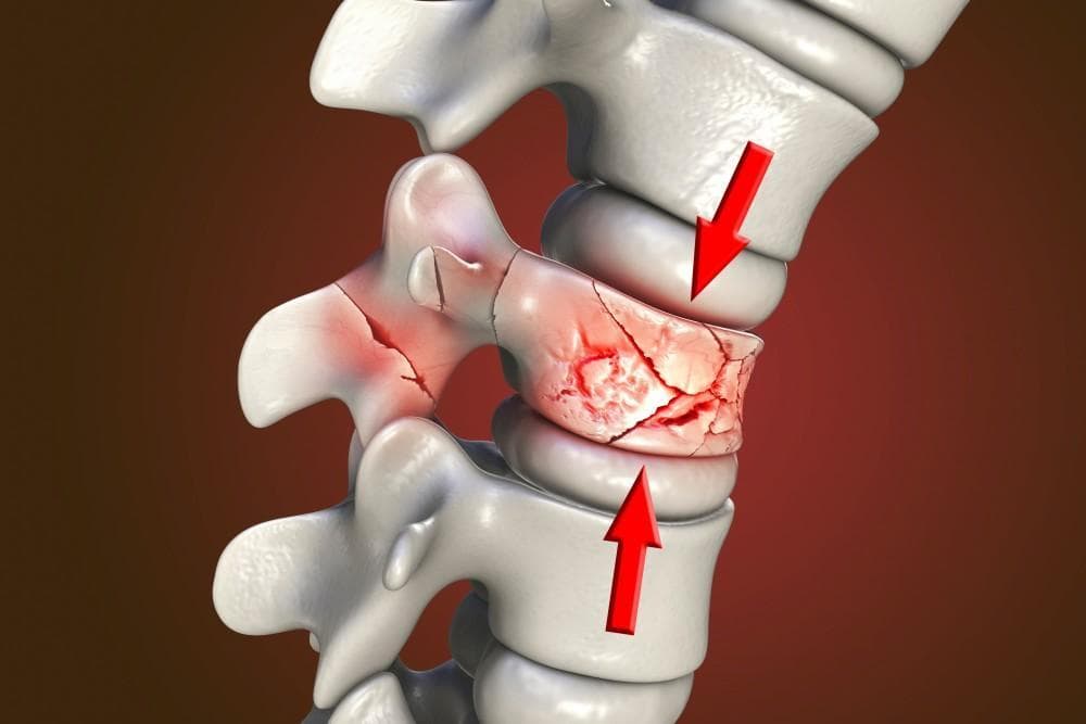 Compression Fractures