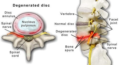 Degenerative Disc Disease (DDD)