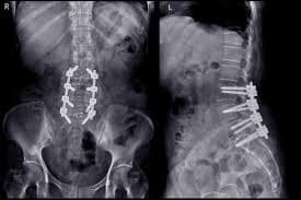 Failed Back Surgery Syndrome (FBSS)