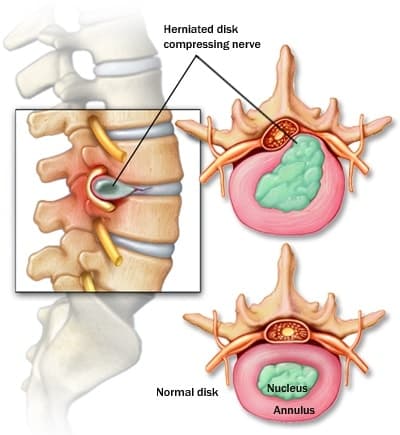 Herniated Discs