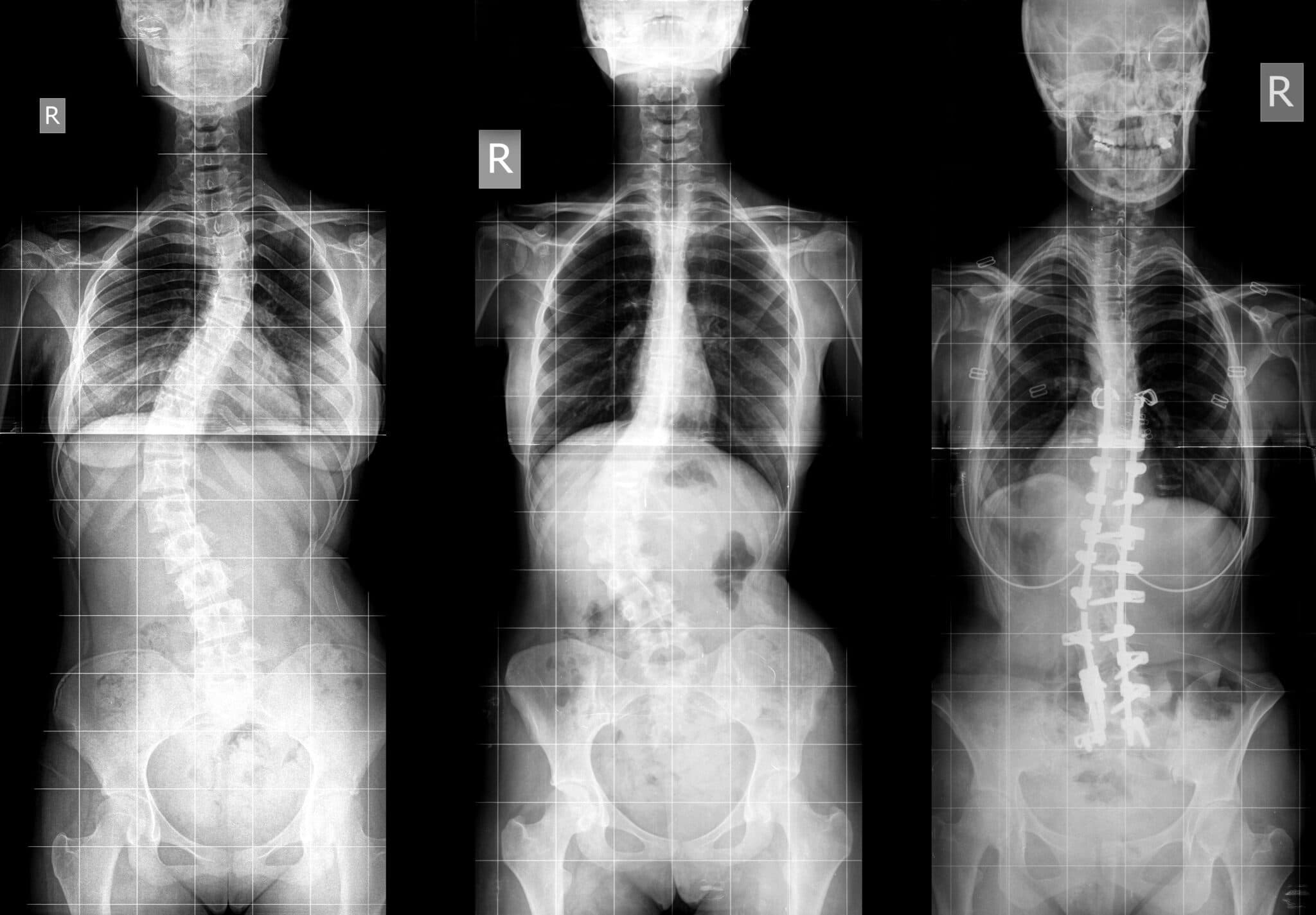 Pediatric Scoliosis