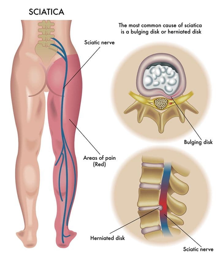 Radiculopathy (Sciatica / Pinched Nerve)
