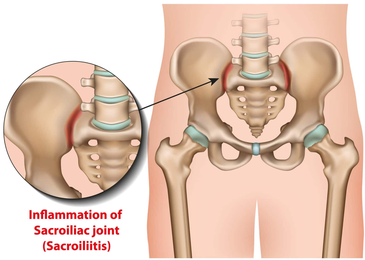 Sacroiliac (SI) Joint Pain
