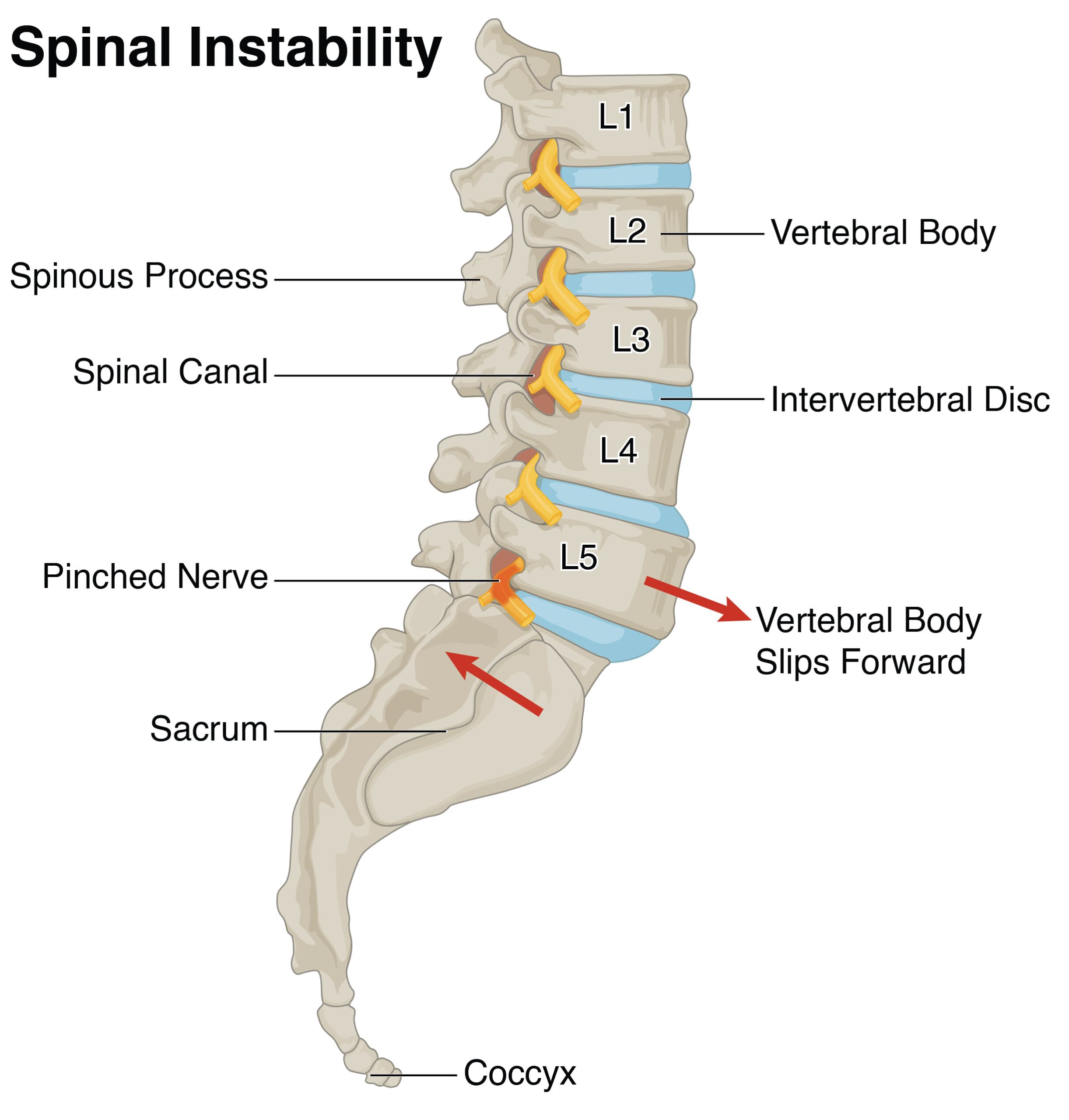 Spondylolisthesis (Spinal Instability)
