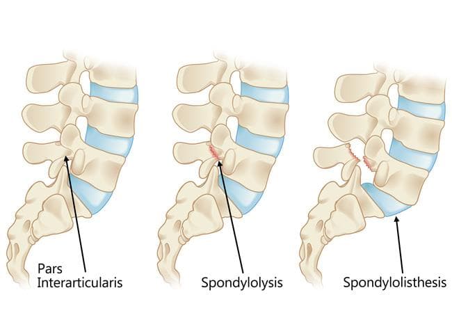 Spondylolysis (Pars Fracture)