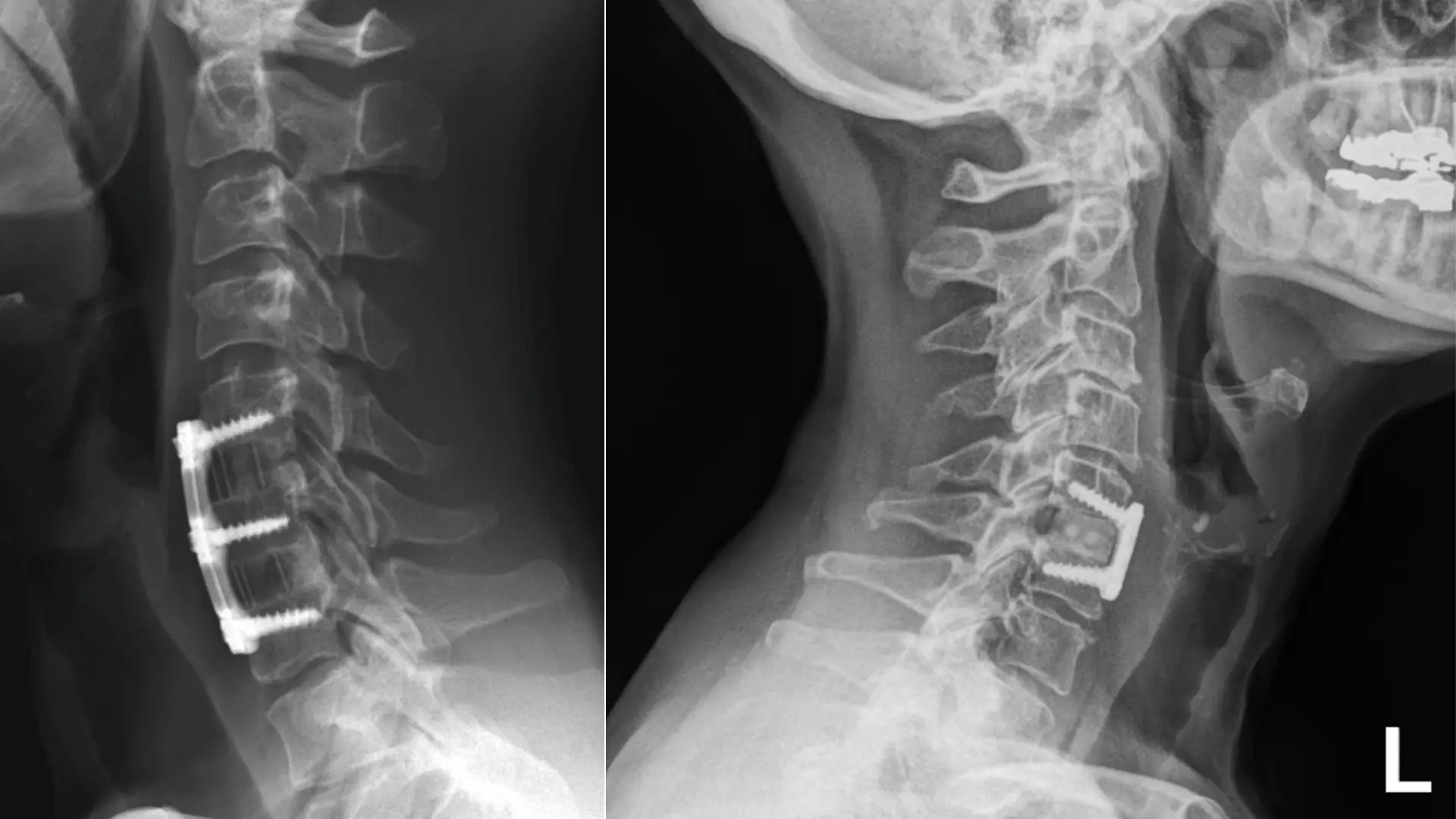 Anterior Cervical Discectomy and Fusion (ACDF)
