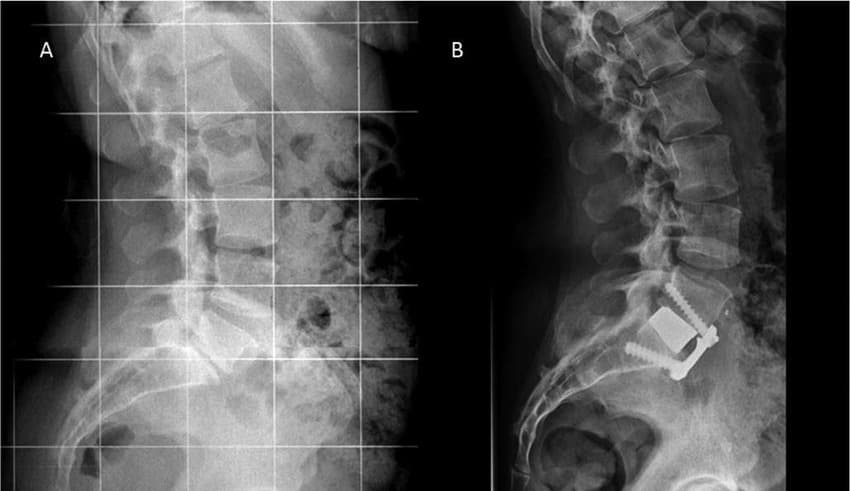 Anterior Lumbar Interbody Fusion (ALIF)