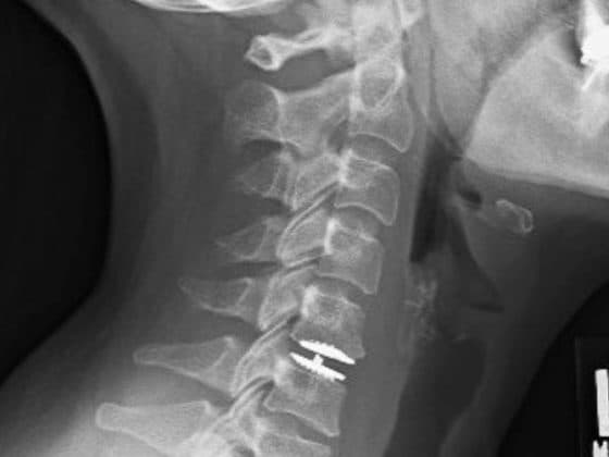 Cervical Disc Replacement