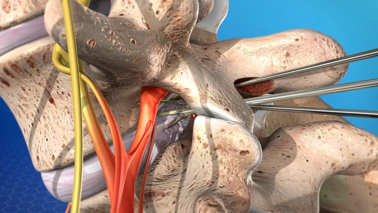 Discectomy