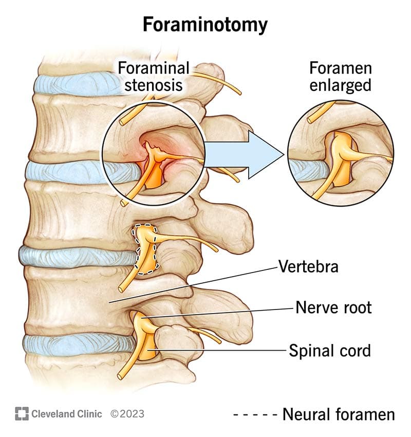 Foraminotomy