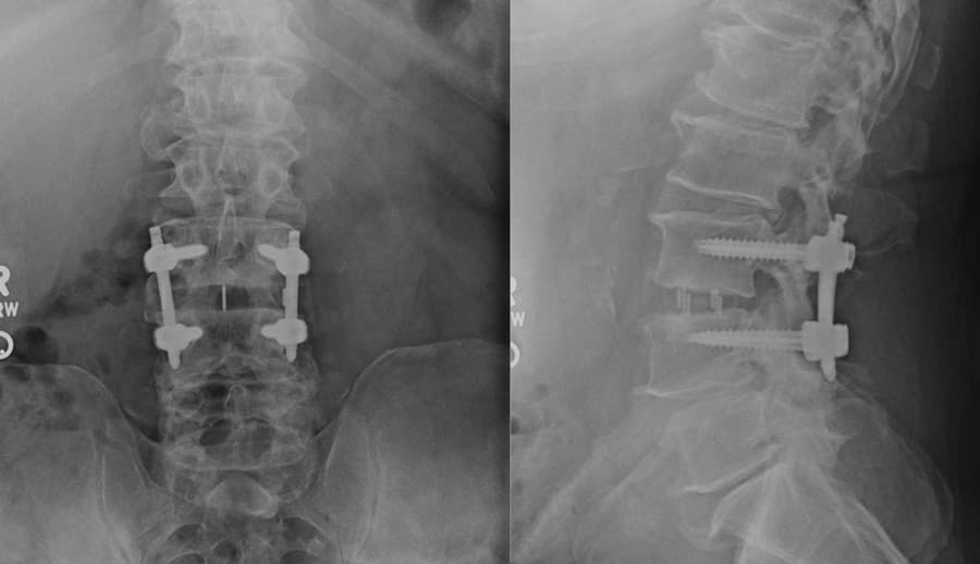 Lateral Lumbar Interbody Fusion (LLIF)