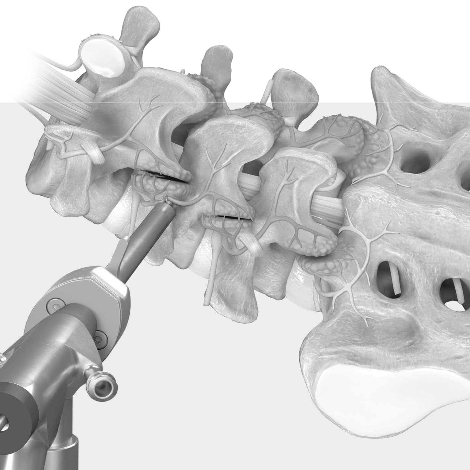 Medial Branch Transection
