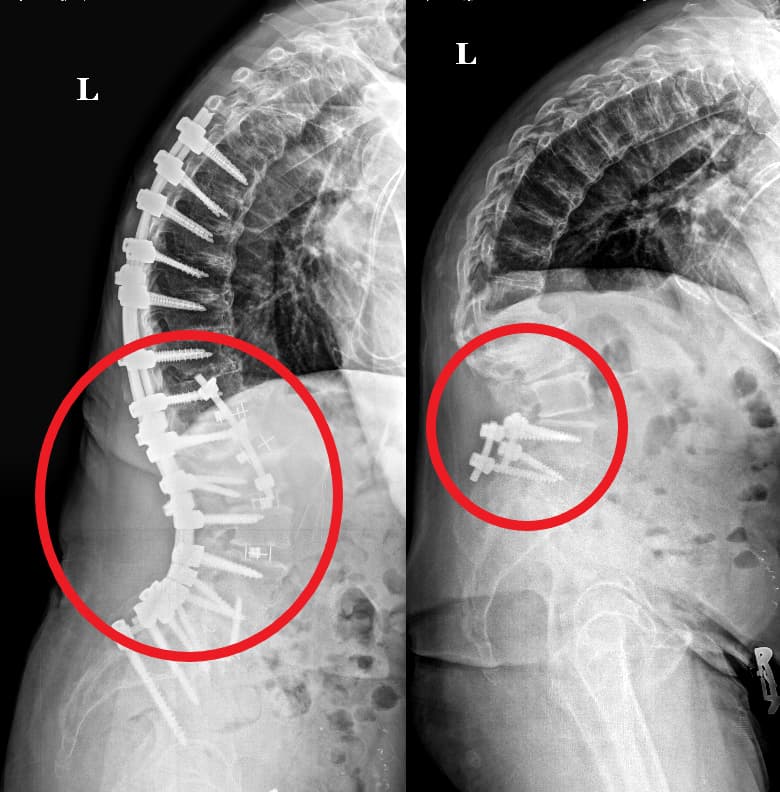 Revision Spine Surgery