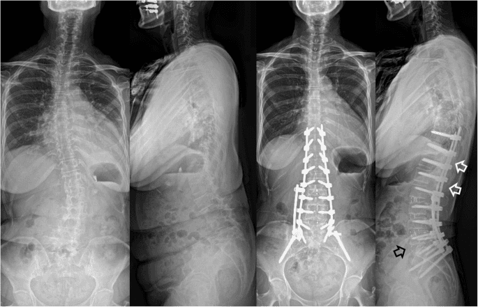 Scoliosis Deformity Correction