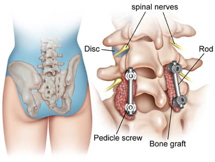 Transforaminal Lumbar Interbody Fusion (TLIF)