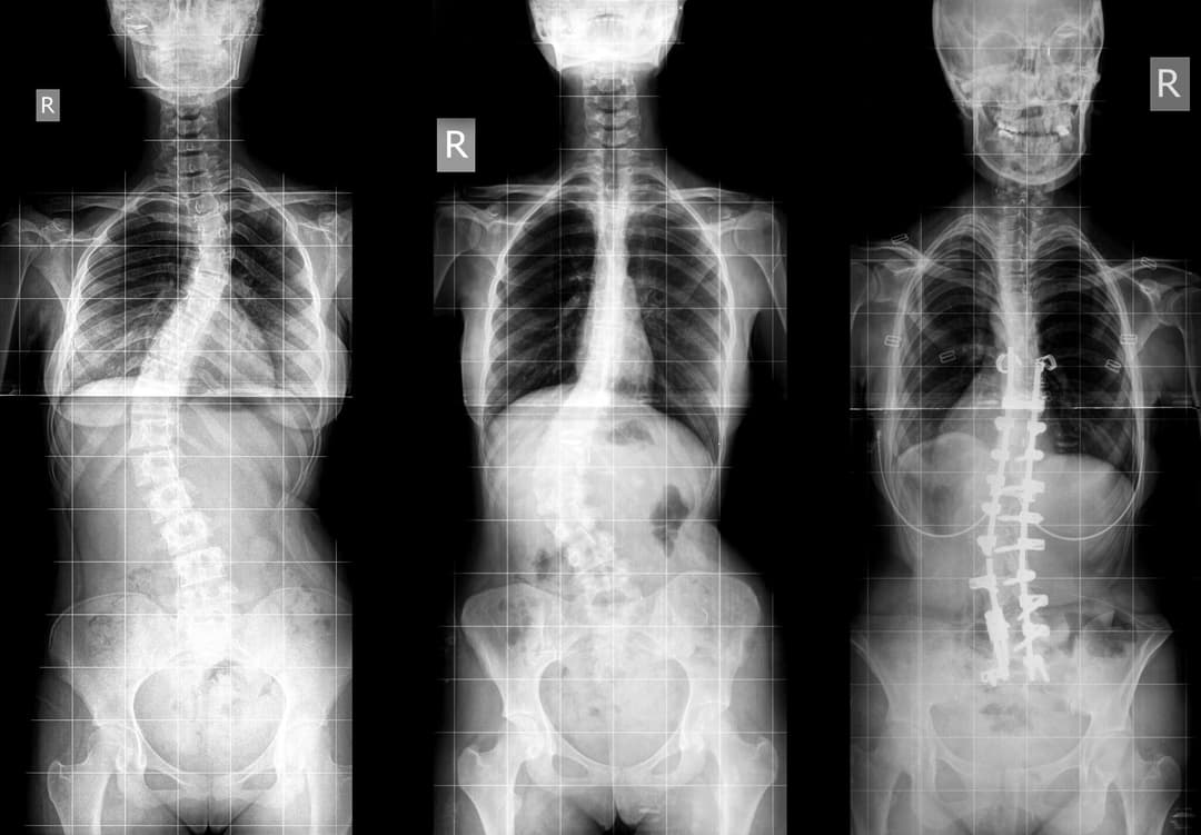 Pediatric Scoliosis (Adolescent Idiopathic Scoliosis)