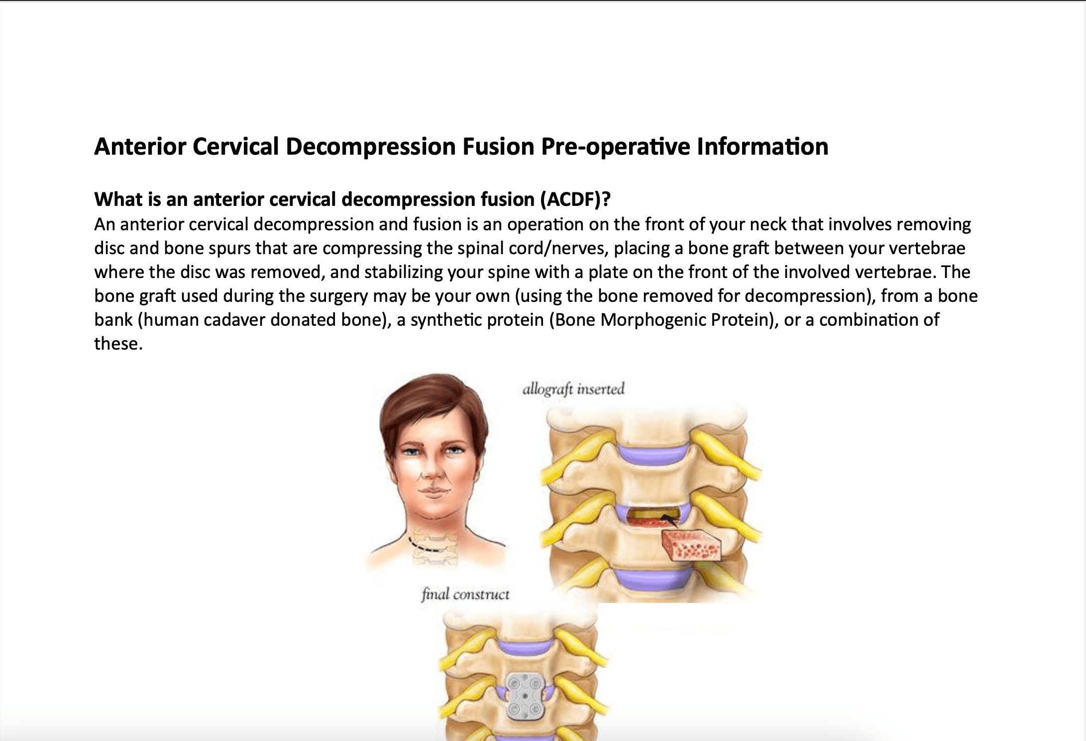 Anterior Cervical Discectomy and Fusion