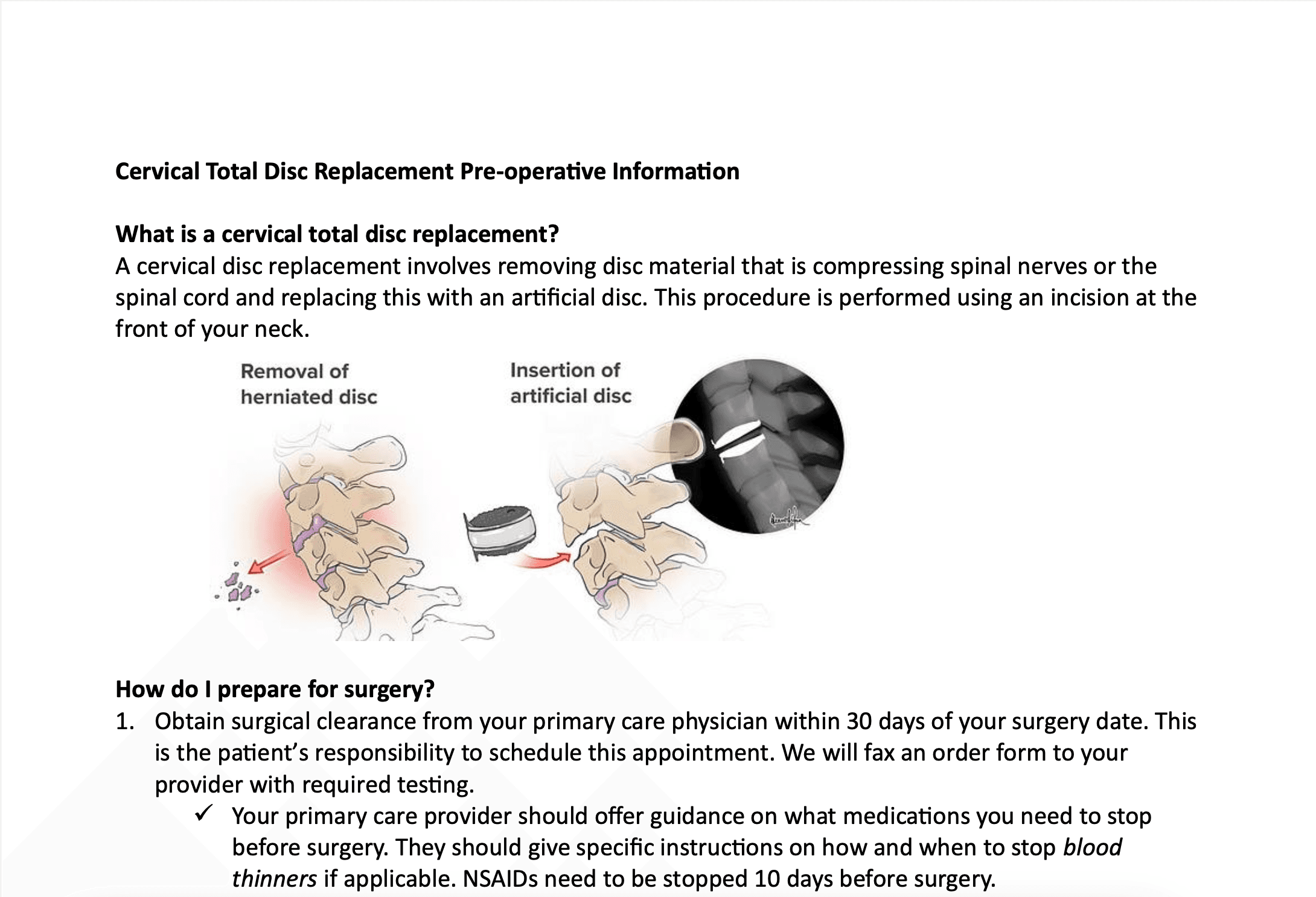 Cervical Total Disc Replacement