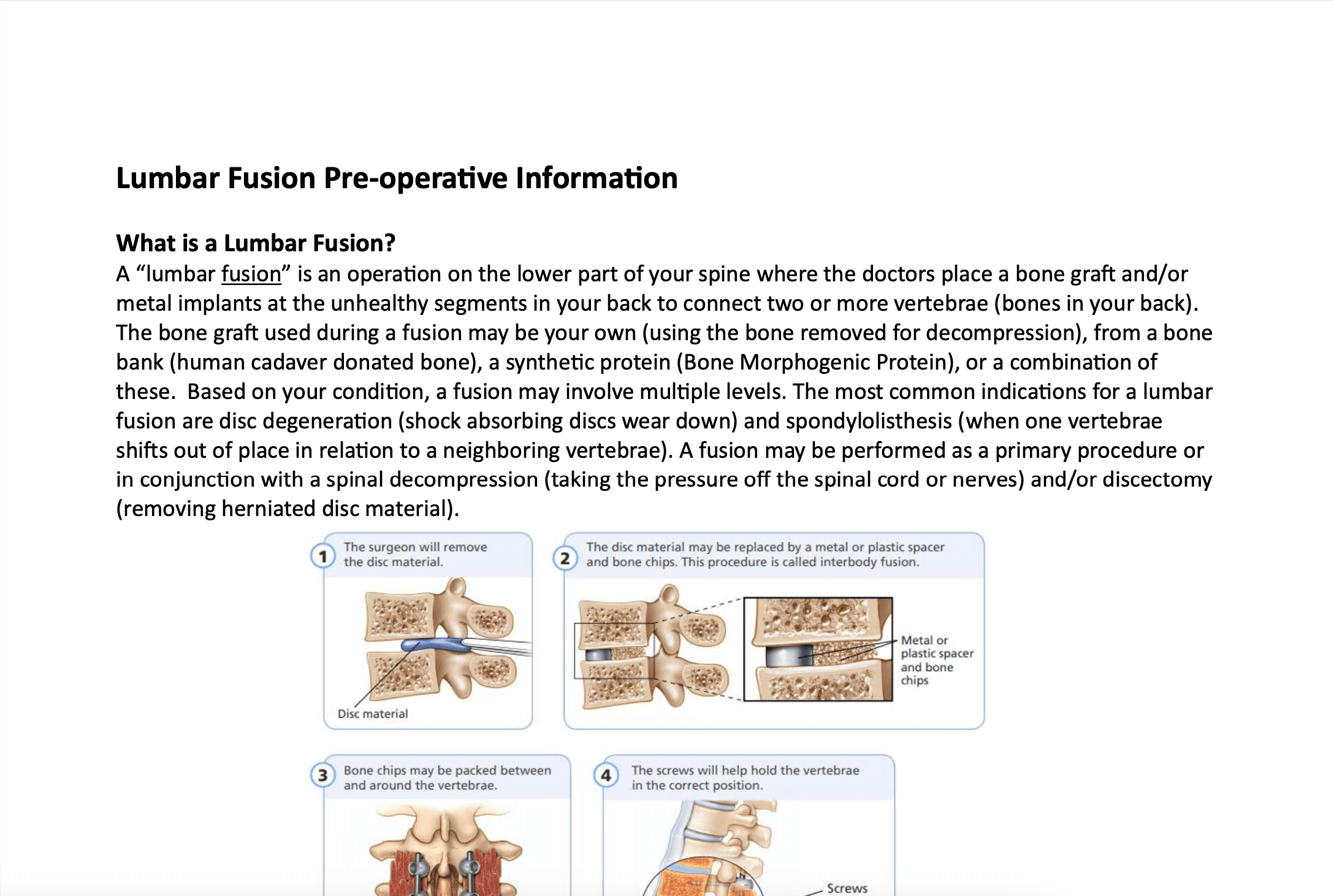 Lumbar Fusion
