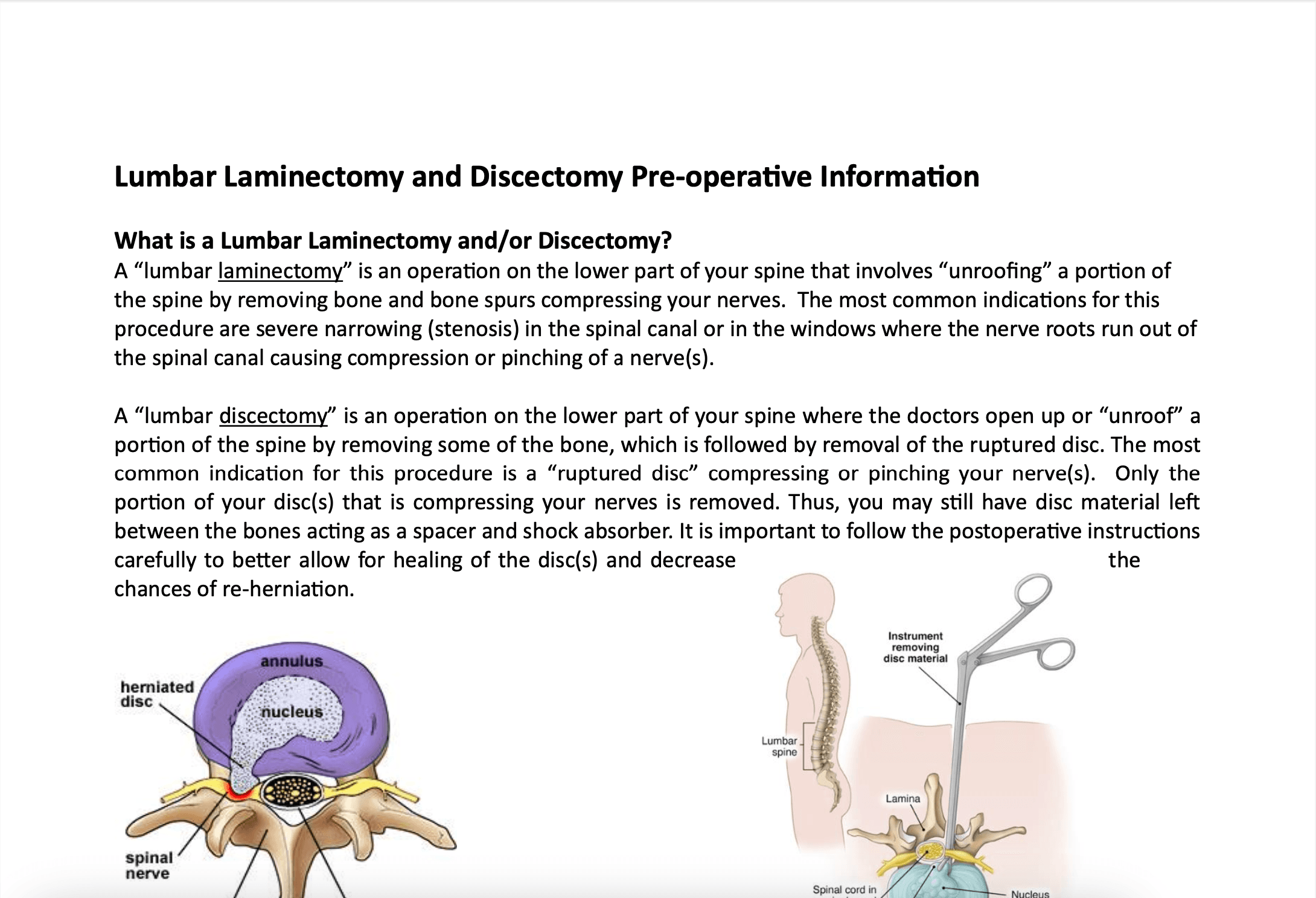 Lumbar Laminectomy and Discectomy