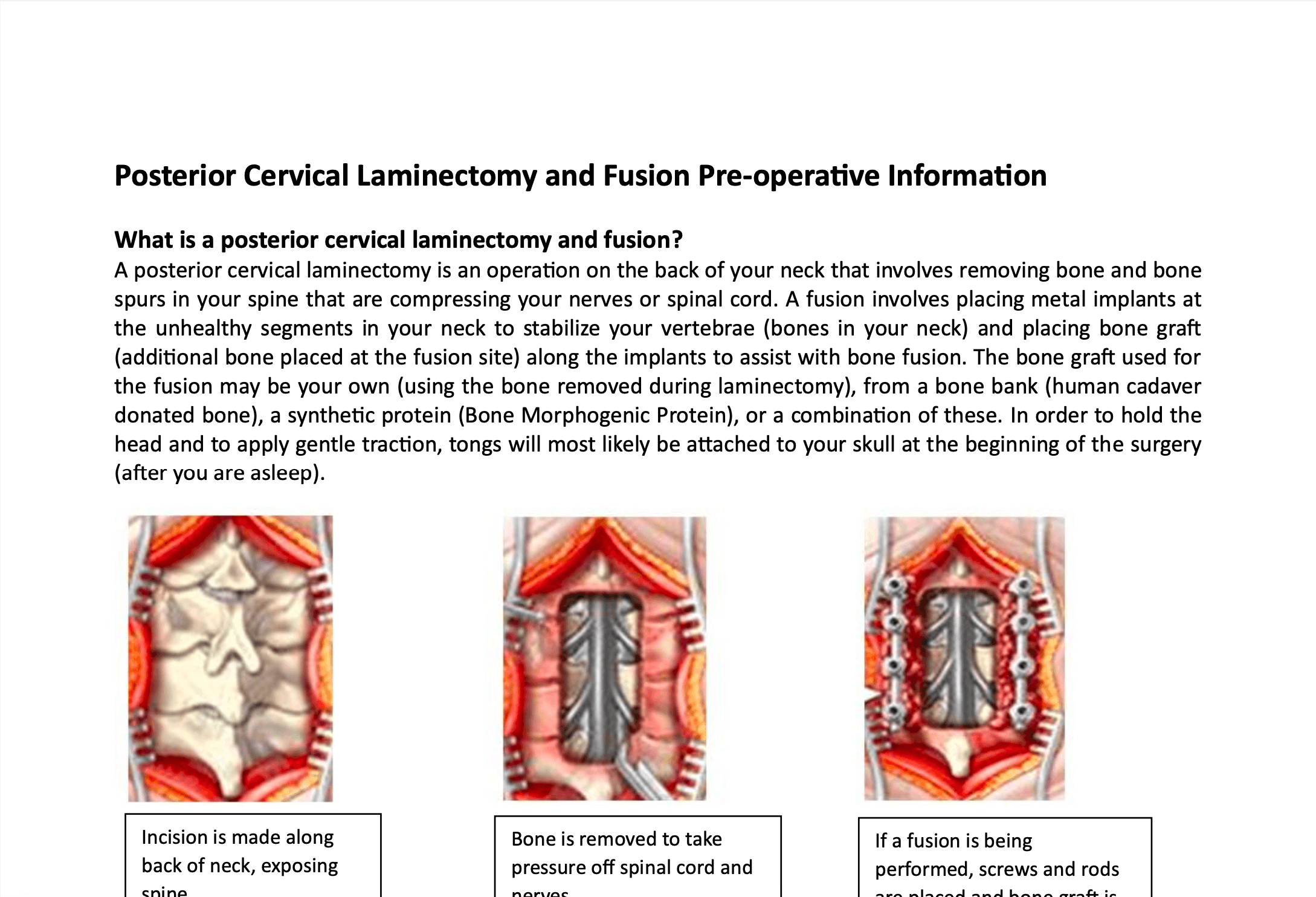 Posterior Cervical Laminectomy & Fusion